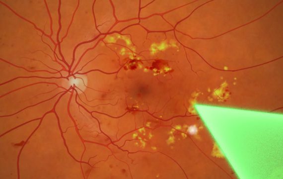 Focal Macular Laser