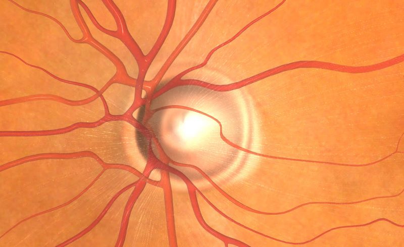 Glaucoma