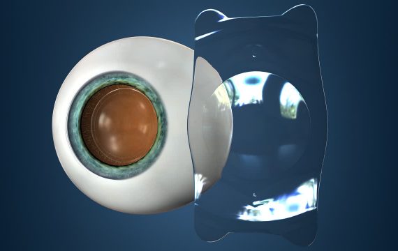 Intraocular Collamer Lens (ICL)