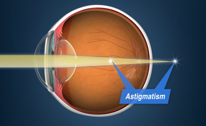 Astigmatism