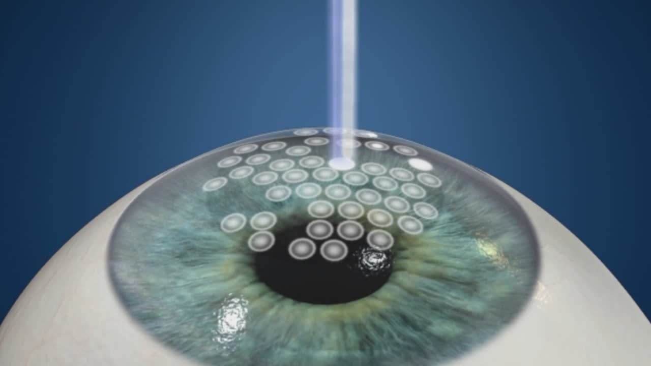 Asla prk freedom eye laser freedom eye laser