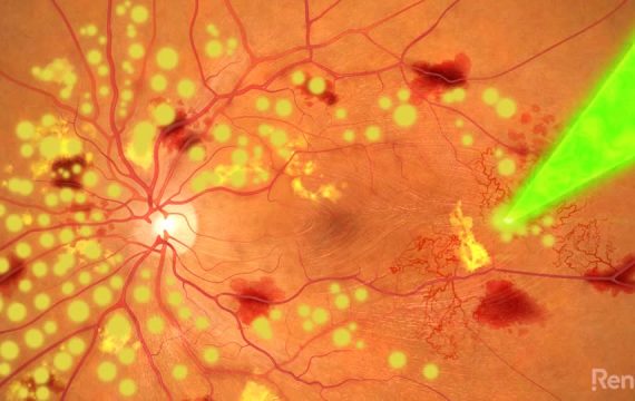 PRP - Pan Retinal Photocoagulation