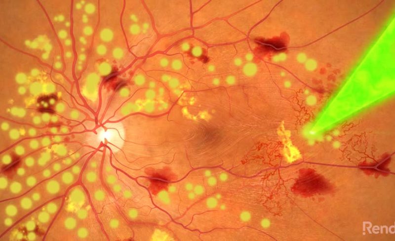 PRP – Pan Retinal Photocoagulation