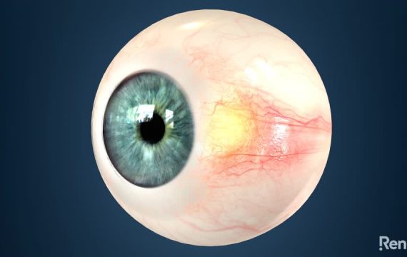 Pinguecula Excision