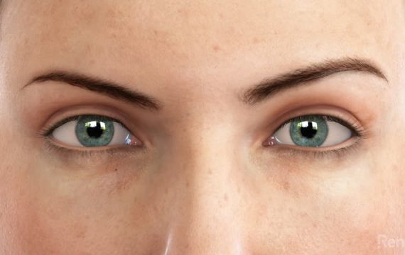 Blepharoplasty