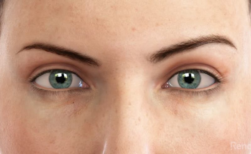 Blepharoplasty