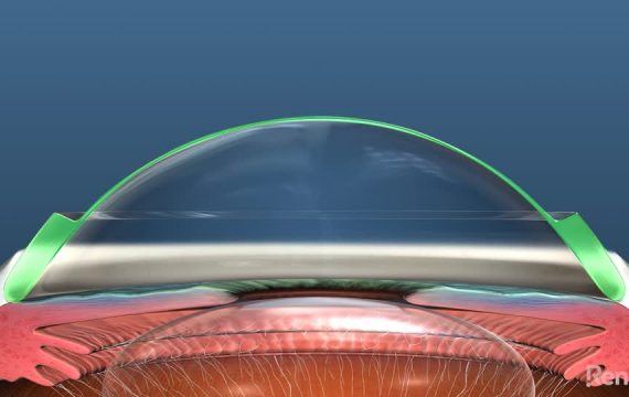 Corneal Transplant - DALK