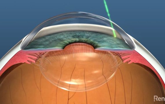 Selective Laser Trabeculoplasty