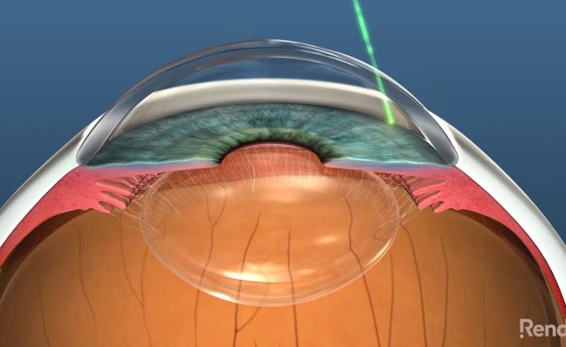 Selective Laser Trabeculoplasty