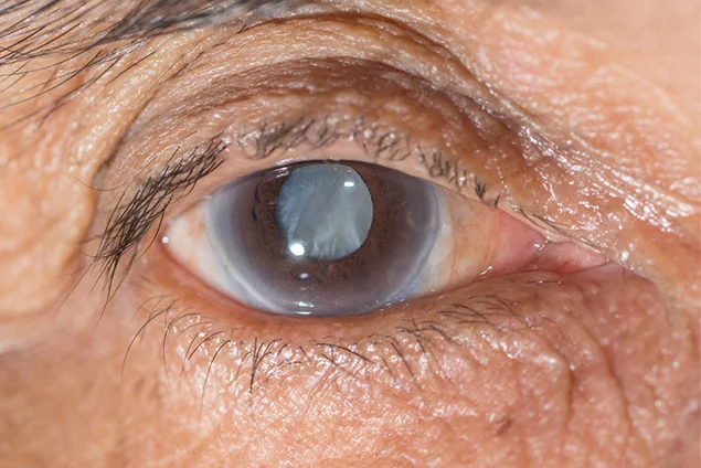 What are cataracts and their causes?