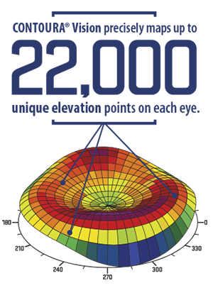 Contoura Vision LASIK Results Achieved