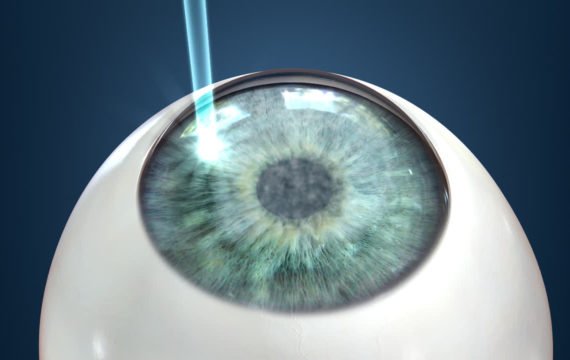 LASIK - 20 to 45 years