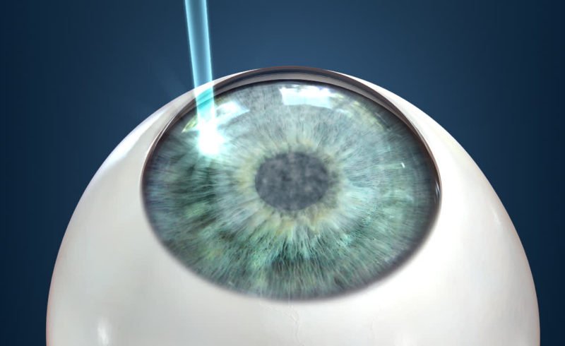 LASIK – 20 to 45 years