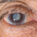 Can Cataract Symptoms Affect Your Mental Health?