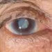 Can Cataract Symptoms Affect Your Mental Health?