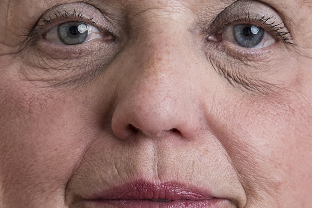 How Old Is Too Old For Eyelid Surgery?
